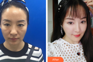 佛山貝爾美醫(yī)學(xué)美容整形醫(yī)院陳海燕整形價(jià)格表附埋線提升案例展示