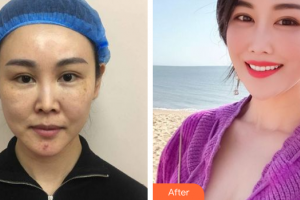 佛山瑞芙臣?jí)袈夺t(yī)學(xué)整形美容醫(yī)院SarahKim整形價(jià)格表附埋線提升案例展示