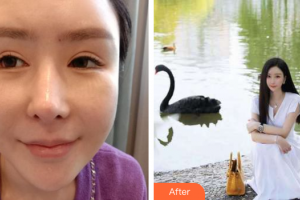 佛山曙光金子醫(yī)學(xué)美容醫(yī)院李淑薇整形價(jià)格表附眼修復(fù)案例展示