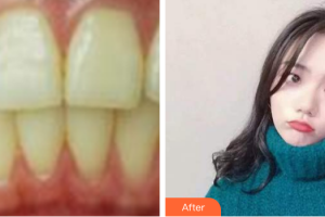 佛山貝爾美醫(yī)學(xué)美容整形醫(yī)院曾強(qiáng)整形價(jià)格表附牙齒冷光美白案例展示