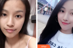 佛山貝爾美醫(yī)學(xué)美容整形醫(yī)院戴耕武整形價(jià)格表附鼻部手術(shù)案例展示