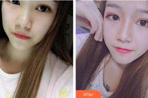 佛山貝爾美醫(yī)學(xué)美容整形醫(yī)院李晟源整形價(jià)格表附鼻部整形案例展示