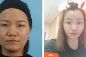 佛山市順德區(qū)北滘醫(yī)院整形美容科陸巍整形價(jià)格表附祛痘補(bǔ)水案例展示