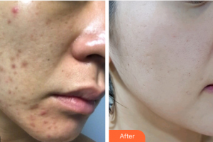 佛山顏植醫(yī)療美容門診部曾碧江整形價(jià)格表附微針祛痘坑痘印案例展示