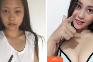 佛山華美整形美容醫(yī)院陳聽柿整形價(jià)格表附假體隆胸案例展示
