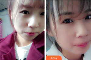 佛山市順德區(qū)北滘醫(yī)院整形美容科段紅梅整形價(jià)格表附激光點(diǎn)痣案例展示