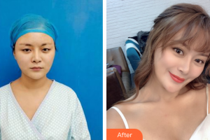 佛山東康整形美容門診部何鎮(zhèn)宇整形價(jià)格表附五維錨定眼部手術(shù)案例展示