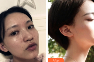 佛山黛顏人醫(yī)療美容門診部鄧勝群整形價(jià)格表附水光補(bǔ)水案例展示