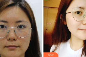 佛山黛顏人醫(yī)療美容門診部李忠隨整形價(jià)格表附面部吸脂案例展示