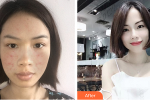 江門瑪麗整形醫(yī)院李慧瓊整形價格表附紅藍(lán)光祛痘案例展示