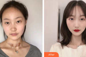 江門市人民醫(yī)院燒傷整形外科梁茶整形價(jià)格表附激光祛疤案例展示