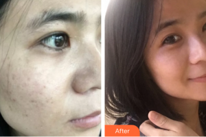 湛江華美整形美容醫(yī)院何慧霞整形價(jià)格表附激光祛斑案例展示