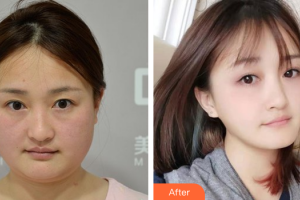 湛江中心人民醫(yī)院燒傷整形手外科陳勁整形價(jià)格表附面部吸脂案例展示