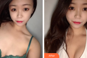 湛江澳泰整形美容醫(yī)院李興均整形價(jià)格表附自體脂肪隆胸案例展示