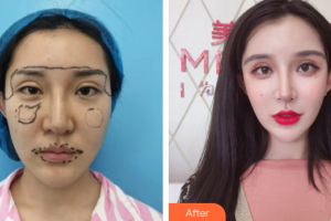 湛江澳泰整形美容醫(yī)院嚴(yán)鐘嫻整形價(jià)格表附埋線提升案例展示