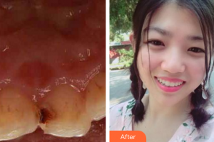 湛江南方口腔醫(yī)院蔡蓮整形價(jià)格表附美容冠案例展示