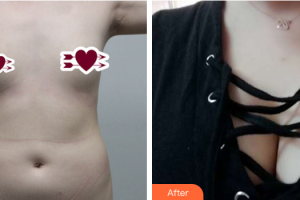 茂名華美整形美容醫(yī)院劉亞飛整形價(jià)格表附自體脂肪豐胸案例展示