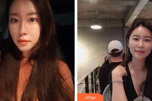 肇慶華美整形美容醫(yī)院涂成芳整形價(jià)格表附激光祛痘案例展示