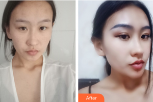 肇慶民和醫(yī)院激光整形科殷運(yùn)成住院醫(yī)師整形價(jià)格表附眼部手術(shù)案例展示