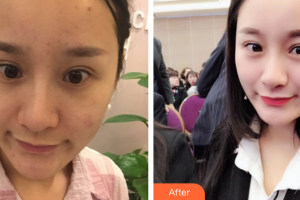 肇慶市皮膚病醫(yī)院醫(yī)療美容科葉偉整形價(jià)格表附去痘印痘坑案例展示