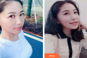 肇慶市皮膚病醫(yī)院醫(yī)療美容科韋方銓整形價(jià)格表附點(diǎn)陣激光祛妊娠紋案例展示