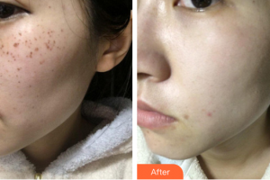 肇慶市皮膚病醫(yī)院醫(yī)療美容科吳曉紅整形價(jià)格表附美國蜂巢激光美膚祛斑案例展示