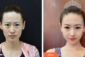 肇慶市皮膚病醫(yī)院醫(yī)療美容科聶金漢整形價(jià)格表附光子嫩膚案例展示