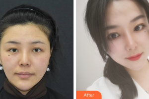 肇慶市皮膚病醫(yī)院醫(yī)療美容科譚以和整形價(jià)格表附激光祛斑案例展示