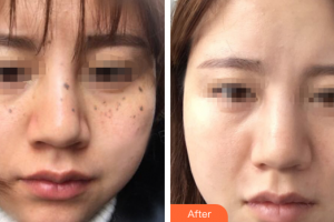 肇慶市皮膚病醫(yī)院醫(yī)療美容科譚波整形價(jià)格表附激光祛斑案例展示