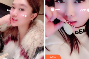 肇慶市皮膚病醫(yī)院醫(yī)療美容科羅中權(quán)整形價(jià)格表附果酸煥膚案例展示