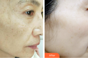 肇慶市皮膚病醫(yī)院醫(yī)療美容科余群英整形價(jià)格表附激光祛斑案例展示