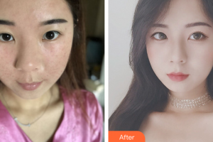 肇慶市皮膚病醫(yī)院醫(yī)療美容科馮嬌娜整形價(jià)格表附去痘印痘坑案例展示