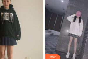 肇慶市皮膚病醫(yī)院醫(yī)療美容科李潔整形價(jià)格表附	縫針疤痕案例展示