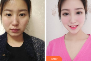 肇慶華美整形美容醫(yī)院饒焱整形價(jià)格表附熱瑪吉案例展示