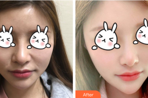 肇慶華美整形美容醫(yī)院蘇暢整形價(jià)格表附熱拉提案例展示