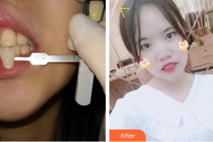 肇慶中大口腔醫(yī)院曾榮華整形價(jià)格表附超聲波潔牙案例展示