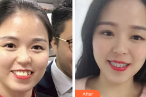 肇慶中大口腔醫(yī)院鐘育軍整形價(jià)格表附自鎖矯正案例展示