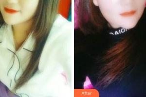 肇慶中大口腔醫(yī)院周永標(biāo)整形價(jià)格表附時(shí)代天使矯正案例展示