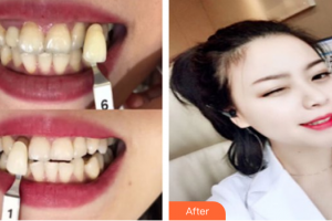 肇慶中大口腔醫(yī)院古善廷整形價(jià)格表附冷光美白案例展示