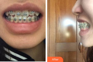 肇慶中大口腔醫(yī)院伍建庭整形價(jià)格表附金屬矯正案例展示