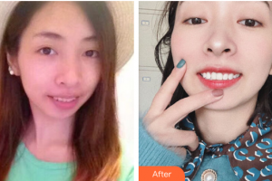 肇慶中大口腔醫(yī)院鐘鏡亮整形價(jià)格表附自鎖矯正案例展示