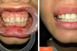 肇慶中大口腔醫(yī)院賴萬方整形價(jià)格表附美加超薄牙貼面案例展示