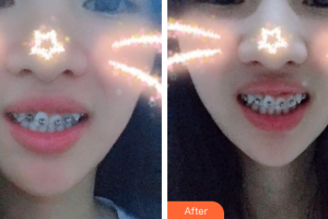 肇慶中大口腔醫(yī)院韋芳梅整形價(jià)格表附自鎖托槽矯正案例展示