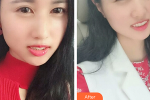 肇慶中大口腔醫(yī)院伍雪紅整形價(jià)格表附全瓷貼面案例展示