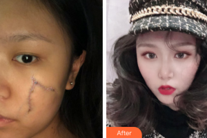 梅州市人民醫(yī)院燒傷整形科何國 整形價(jià)格表附縫針疤痕案例展示