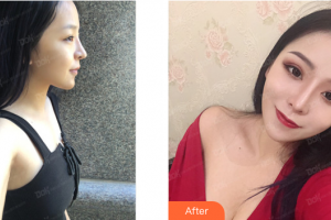 梅州市人民醫(yī)院燒傷整形科曾運(yùn)泉 整形價(jià)格表附假體隆胸案例展示