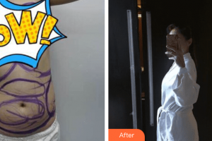 梅州方圓醫(yī)療美容門診部楊斌整形價(jià)格表附全身吸脂+脂肪豐胸案例展示