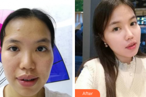 梅州諾麗醫(yī)療美容門診部杜國華整形價(jià)格表附自體脂肪全臉填充案例展示