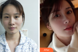 梅州諾麗醫(yī)療美容門診部王利整形價(jià)格表附眼部綜合案例展示