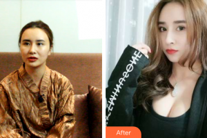 梅州曙光醫(yī)療美容醫(yī)院整形價格表附自體脂肪隆胸案例展示